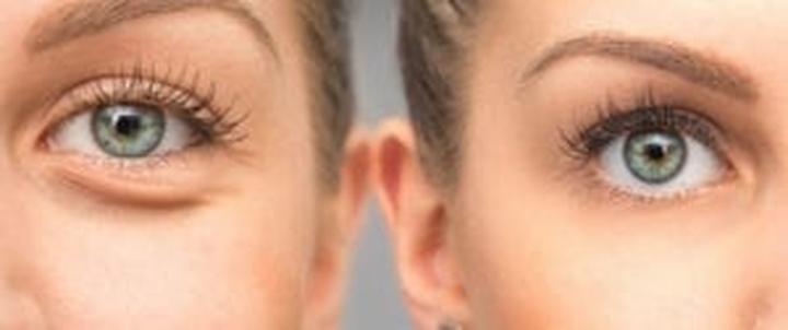 Przygotowanie do blefaroplastyki dolnej